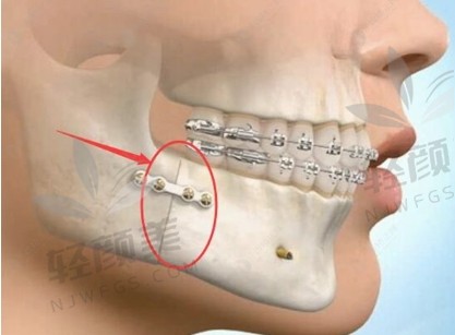 西安正颌手术医院排名，告诉你西安哪里能做正颌手术！