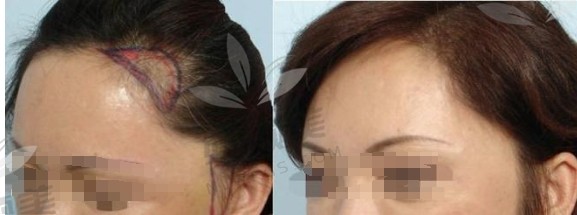发际线种植手术案例分享：全程护理详解，看图感受头发重生的喜悦