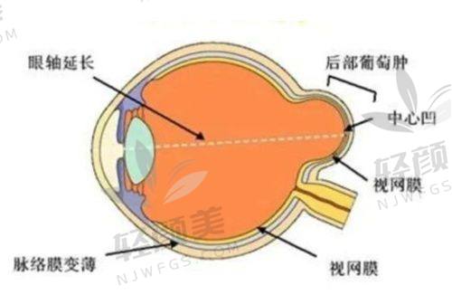 三、“有些人植入后还是当兵了”，是怎么回事？