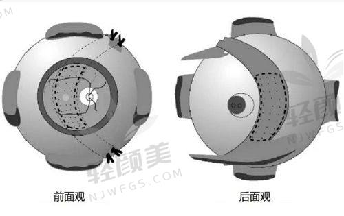 二、做了ICL晶体植入能不能当兵？法定怎么说