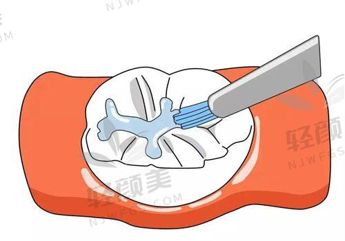 2. 濮阳窝沟封闭多少钱？——小城市也有高性价比