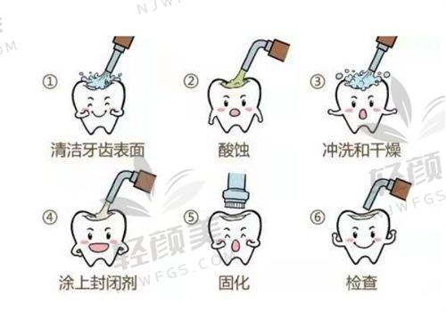 1. 深圳窝沟封闭多少钱？——精致城市也有性价比