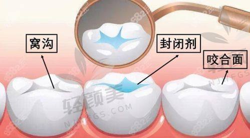 三、热门城市窝沟封闭价格大比拼（附各地真实花费）