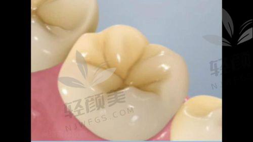 六、为啥孩子一定要做窝沟封闭？不做真的亏大了！