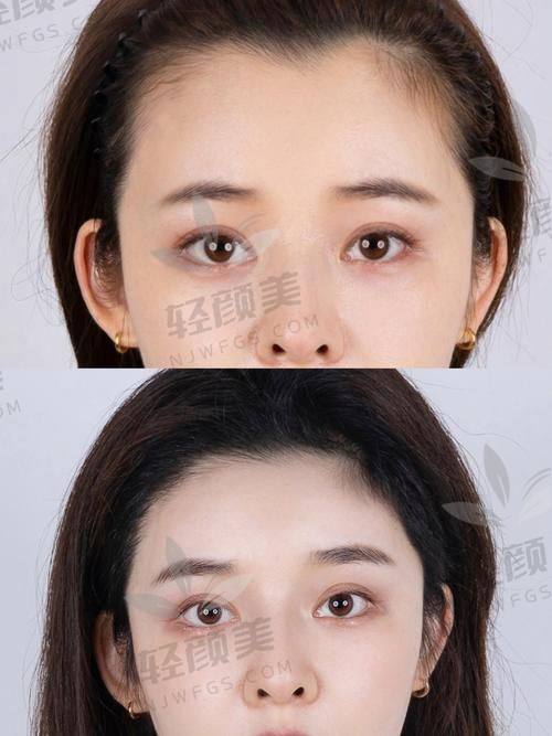 植发费用揭秘 —— 不想被割韭菜请认准这几件事