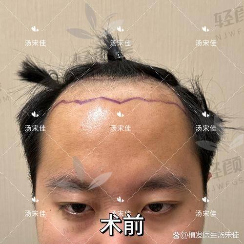 想知道植发 5 年后的真实感受？从效果、费用到护理全攻略都在这！