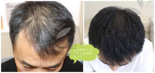 术后1年累觉不爱，术后3年惊艳逆袭