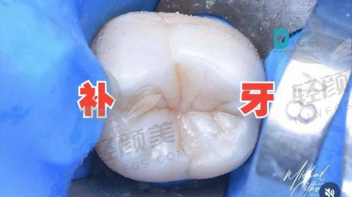 树脂补牙价格一览表全解析：不同地区、材料价格差异大，省钱攻略在此！