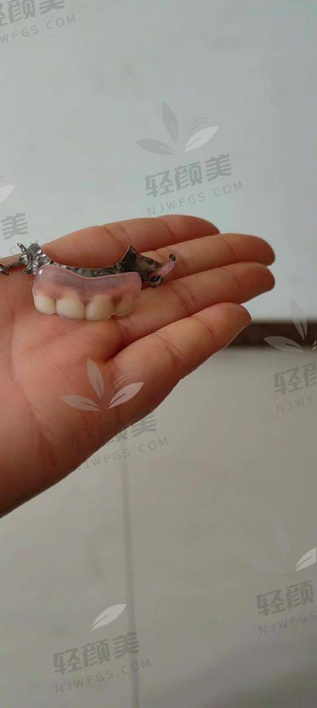 ?价格上看确实比种植牙友好，但别贪便宜！