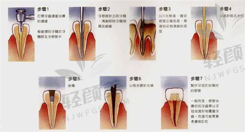 一、牙不痛就不用治疗？有这想法的真的危险！