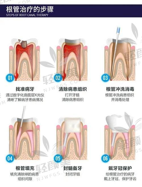 五、根管治疗失败怎么办？别慌，还有二次治疗机会?