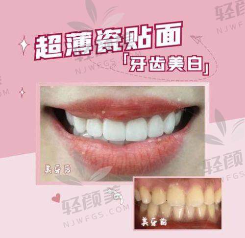 一、2025牙齿贴面价格表曝光！不同品牌差价竟如此大，真相究竟如何？