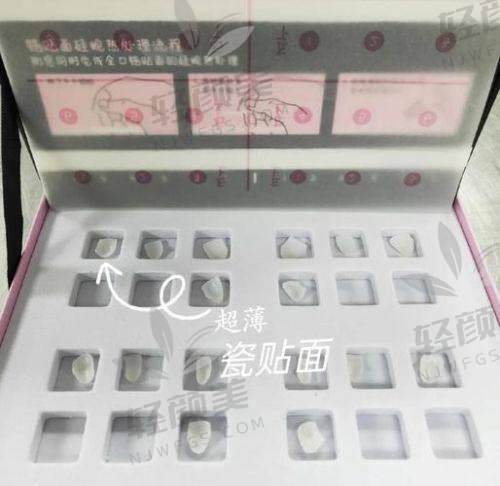 五、火遍全网的品牌贴面价格对比表，哪个才是你的性价比之选？