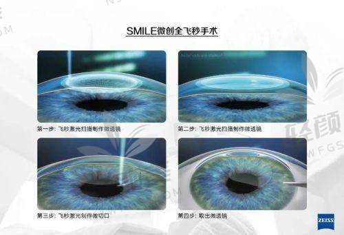 三、我的手术实录全过程：从术前检查到术后1个月恢复进展