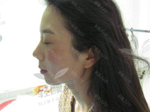 一、2025肋骨隆鼻手术价格正式曝光！不同医院价格对比解析
