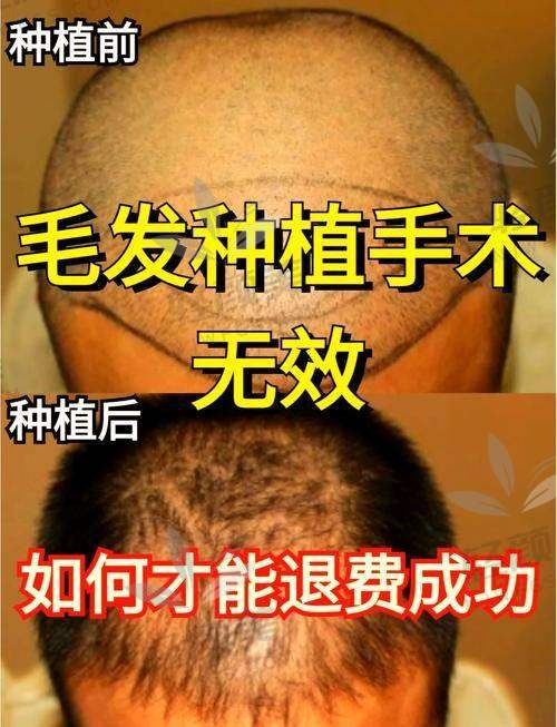 02｜不同植发技术消耗的预算值不一样！一万块能种多少毛囊单位？
