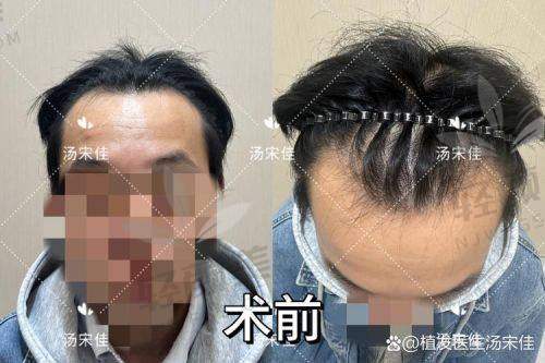 01｜植发到底按什么算钱？不是按“面积”，而是按“毛囊单位”！