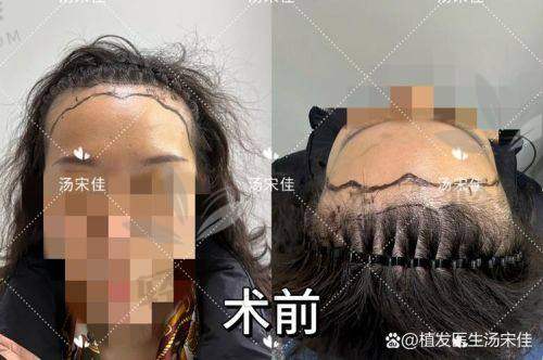 06｜一万块种得值不值？关键看术后成效