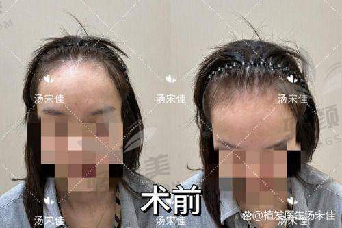 03｜一万块只能植500单位？那到底多大面积能搞定？
