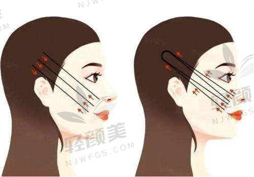 二、下定决心做拉皮的48小时冲动时刻
