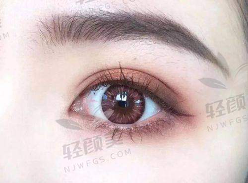 四、术后恢复日记——谁说修复术痛苦？在张姣姣这不成立！