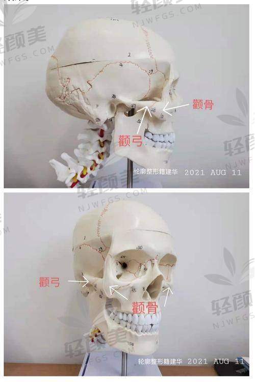四、不同类型的 “问题颧骨” 该怎么处理？