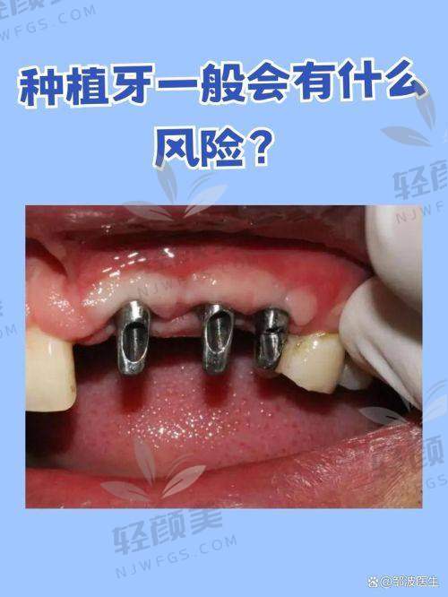 四、瑞士ITI好在哪儿？为啥牙医都推荐？