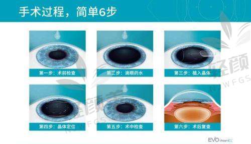什么是晶体植入手术？一副高新科技的“隐形眼镜”打入眼里