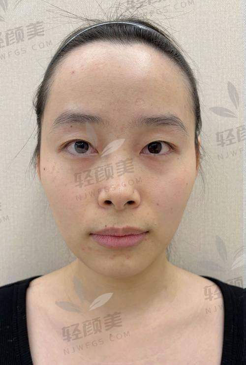 四、谁在偷偷赚差价？不同品牌玻尿酸的“性格对比”来了