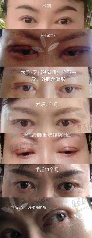 三、拆解眼综合价格组成：医生、设备、术后服务都在分钱！