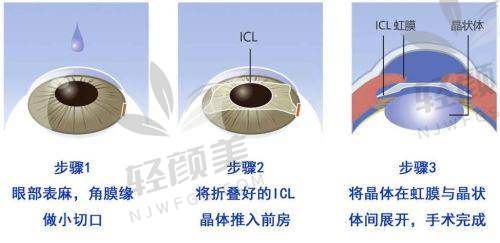 三、三焦点人工晶体到底能不能医疗保险报销？