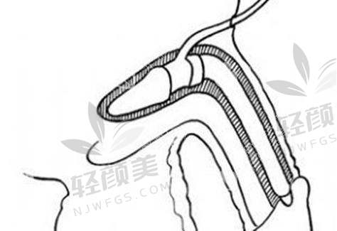 ? 男性生物补片手术多少钱一次？真没你想的那么贵