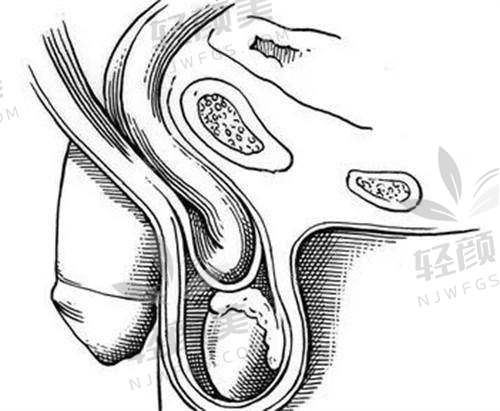 ⚠️ 生物补片手术风险大吗？这些副作用要知道