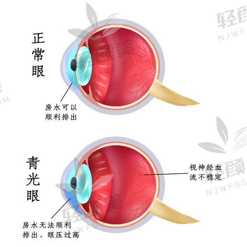 青光眼失明，真就宣告“光明永别”了吗？