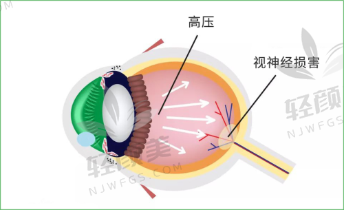 3️⃣ 电子眼植入——从盲到“机器视觉”的希望