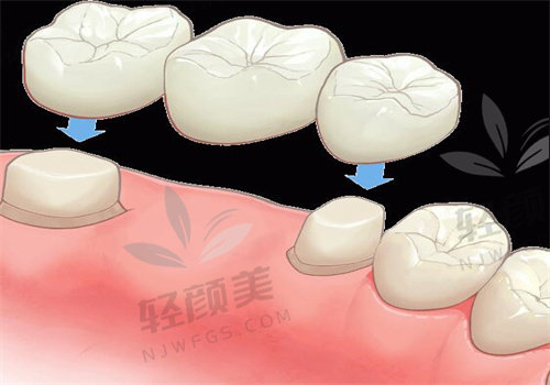 北京大学人民医院口腔科收费价格表，种牙、镶牙、正畸、补牙、根管治疗价格可查