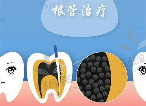 如何避免牙神经疼？重点在这一点