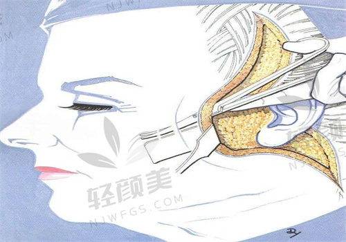 超详细！重庆小拉皮手术多少钱，不同术式价格区间和适合人群大盘点！