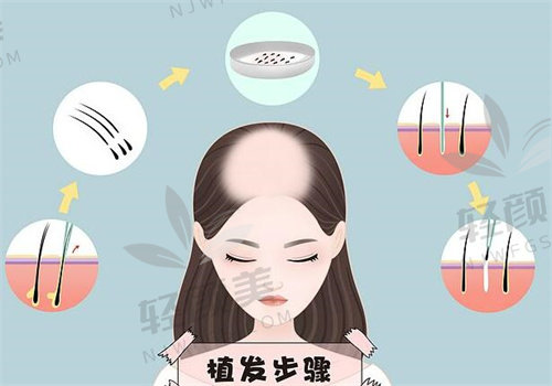 惊！植发可以用别人的毛囊吗？排异反应等难题或让移植毛囊难存活