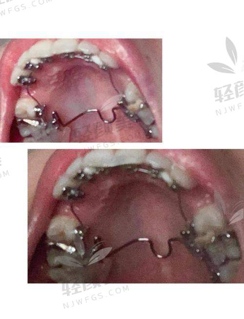舌侧矫正的过程