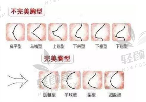 亲测北京嘉禾整形赵希军脂肪隆胸，效果超棒！赵希军医生技术牛，医院靠谱！