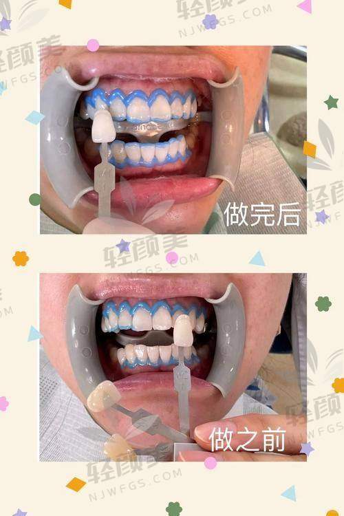 1. 中诺口腔贴面项目价格【靠谱连锁】