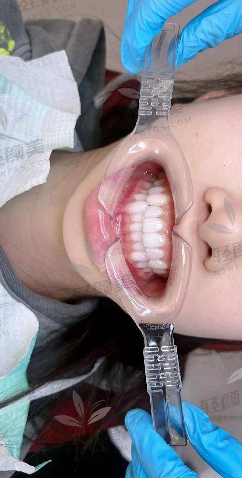 术后护理