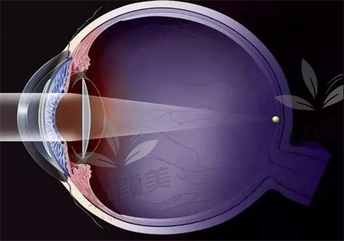亲测北京茗视光周跃华薄瓣飞秒LASIK(VISX) ，保留角膜组织，术后视力清晰超棒！