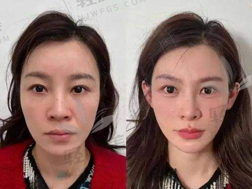 维缇美能维持多久？打一次值不值？