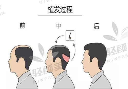 我在北京碧莲盛做了不剃发胡须种植，价格透明，BHT技术超棒，体验绝了！
