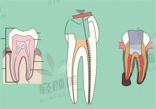 亲身体验北京劲松口腔前牙根管治疗，价格和收费标准咋样，看完分享你就懂！