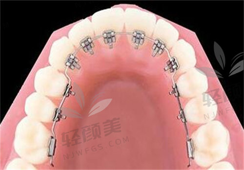 亲身体验北京禾禾黄帅医生舌侧矫正，禾禾齿科黄帅技术牛，不愧是北京舌侧正畸医生！
