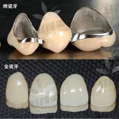 国产 vs 进口全瓷牙品牌谁更香？先上具有影响力排行榜?