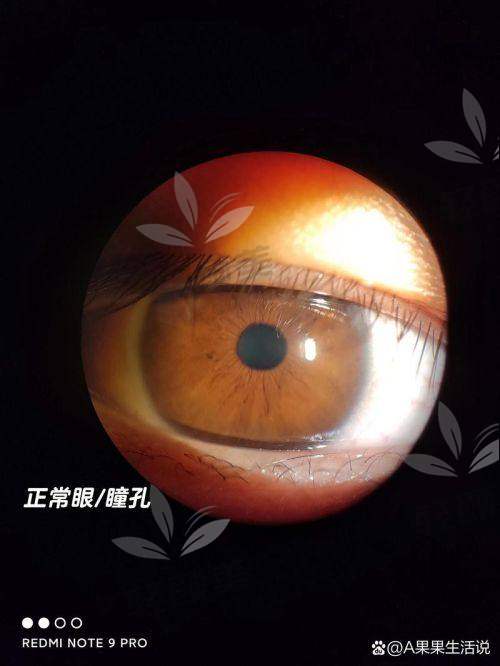 爱尔康晶体 VS 蔡司晶体哪个好？成像、视力、价格大比拼别错过